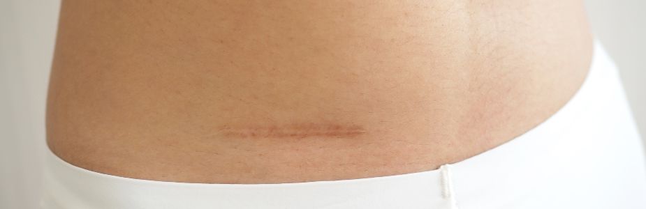 Appendectomy / Intestinal-Obstruction Surgery