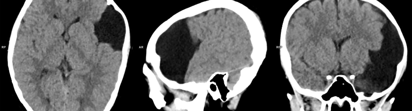 Arachnoid Cysts - Causes, Symptoms, Diagnosis, Treatment, and Prevention