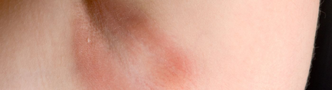 Armpit Yeast Infection - Causes, Symptoms, Diagnosis, Treatment, and Prevention