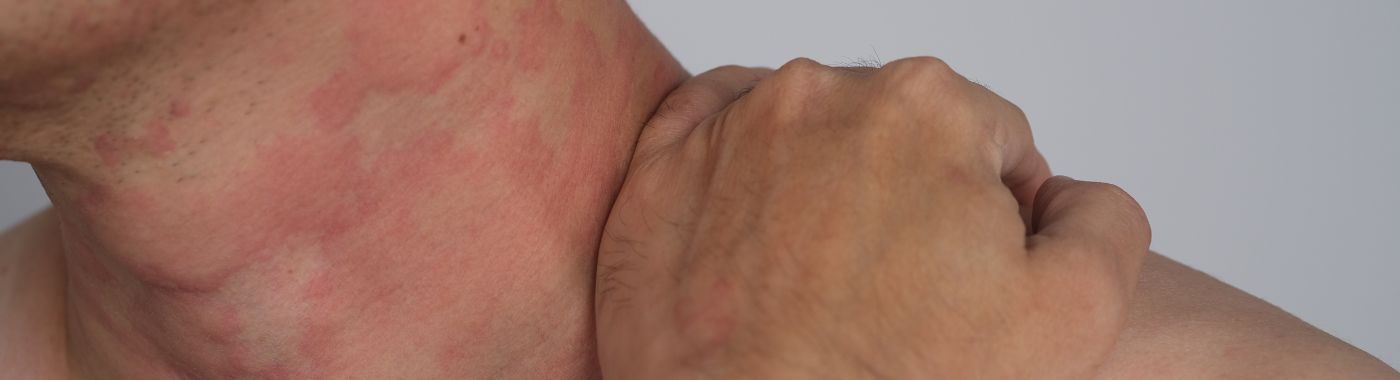 Arthus Reaction - Causes, Symptoms, Diagnosis, Treatment, and Prevention