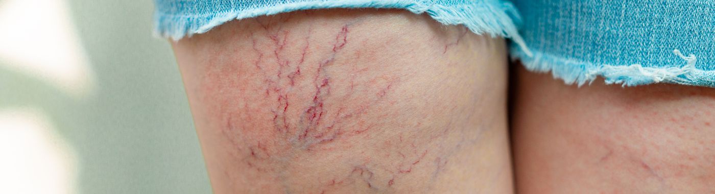 Ataxia Telangiectasia - Causes, Symptoms, Diagnosis, Treatment, and Prevention