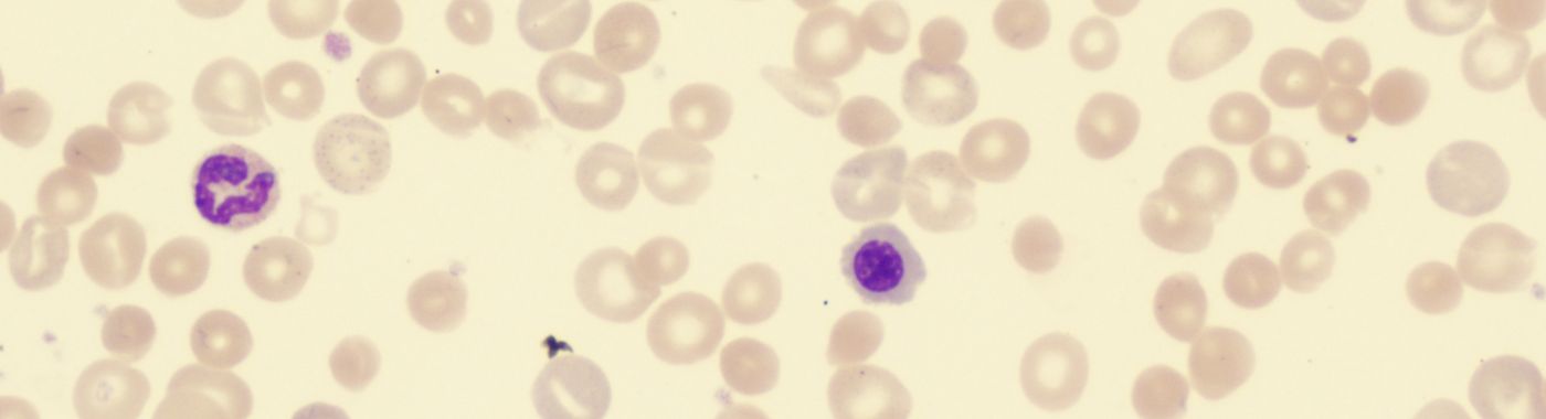 Autoimmune Hemolytic Anemia - Causes, Symptoms, Diagnosis, Treatment, and Prevention