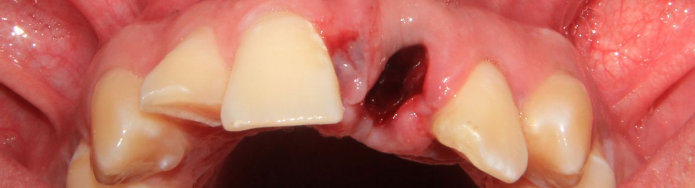Avulsed Tooth - Causes, Symptoms, Diagnosis, Treatment, and Prevention