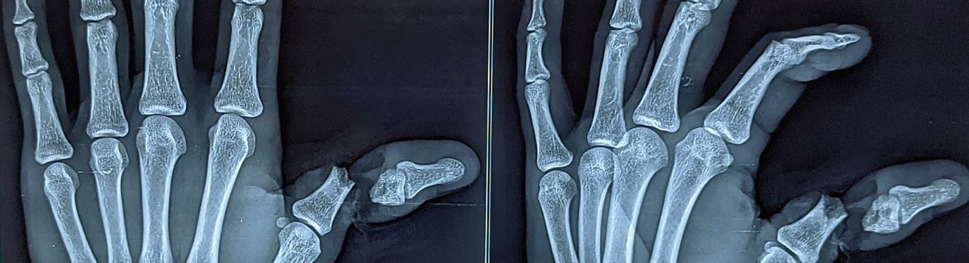 Avulsion Fracture - Causes, Symptoms, Diagnosis, Treatment, and Prevention