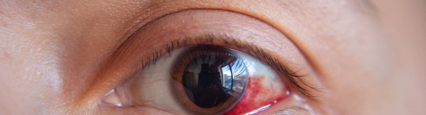 Axenfeld Rieger Syndrome - Causes, Symptoms, Diagnosis, Treatment, and Prevention