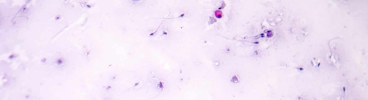 Azoospermia - Causes, Symptoms, Diagnosis, Treatment, and Prevention