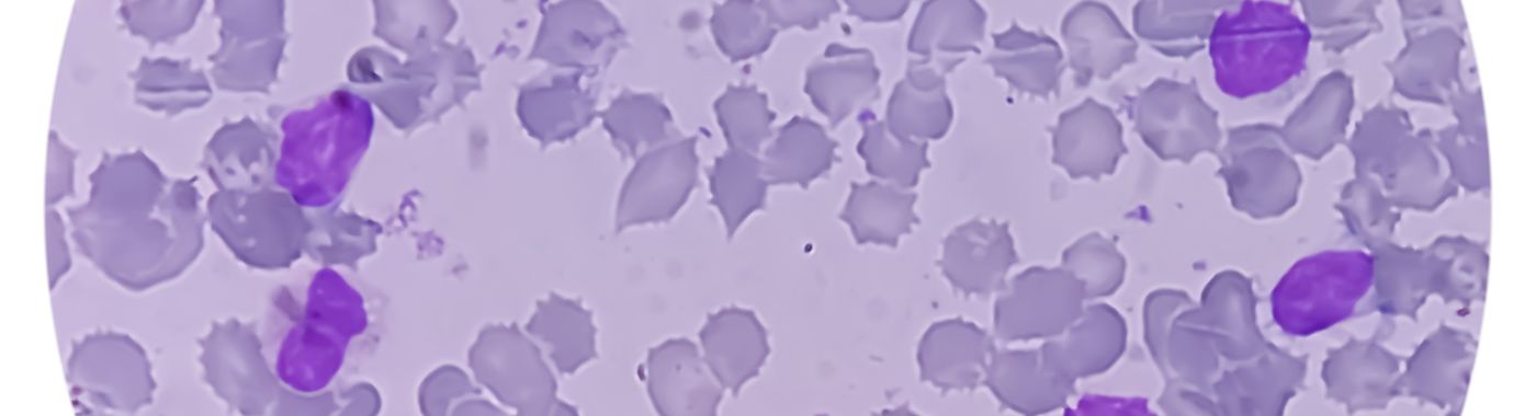 B Cell Lymphoma - Causes, Symptoms, Diagnosis, Treatment, and Prevention