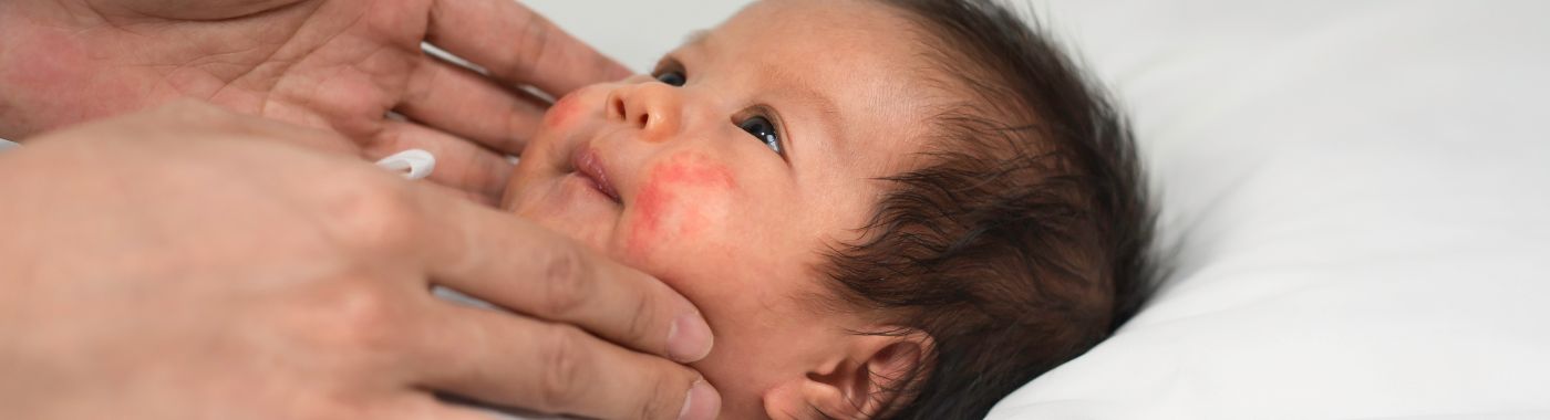 Baby Acne - Causes, Symptoms, Diagnosis, Treatment, and Prevention