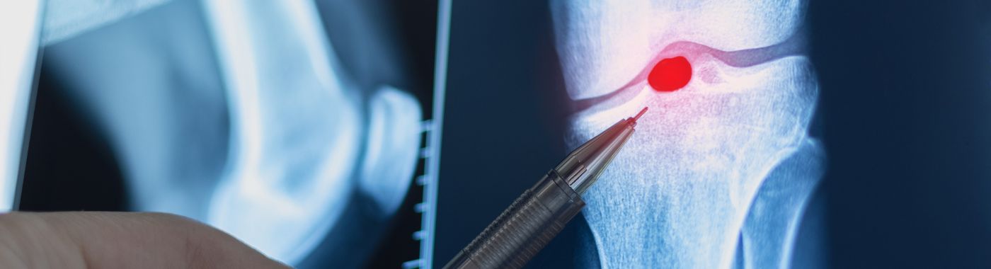 Bakers Cyst - Causes, Symptoms, Diagnosis, Treatment, and Prevention