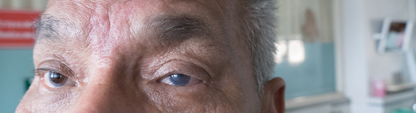 Band Keratopathy - Causes, Symptoms, Diagnosis, Treatment, and Prevention