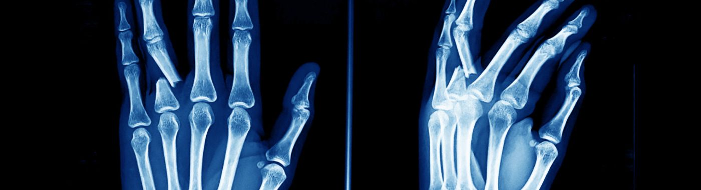 Barton Fracture - Causes, Symptoms, Diagnosis, Treatment, and Prevention