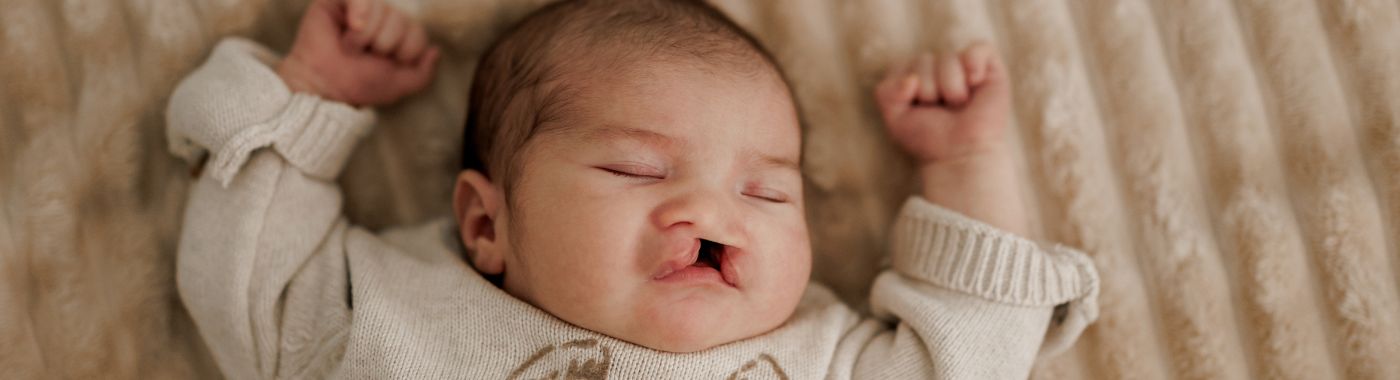 Beckwith Wiedemann Syndrome - Causes, Symptoms, Diagnosis, Treatment, and Prevention