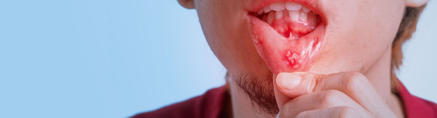 Behcets Disease - Causes, Symptoms, Diagnosis, Treatment, and Prevention