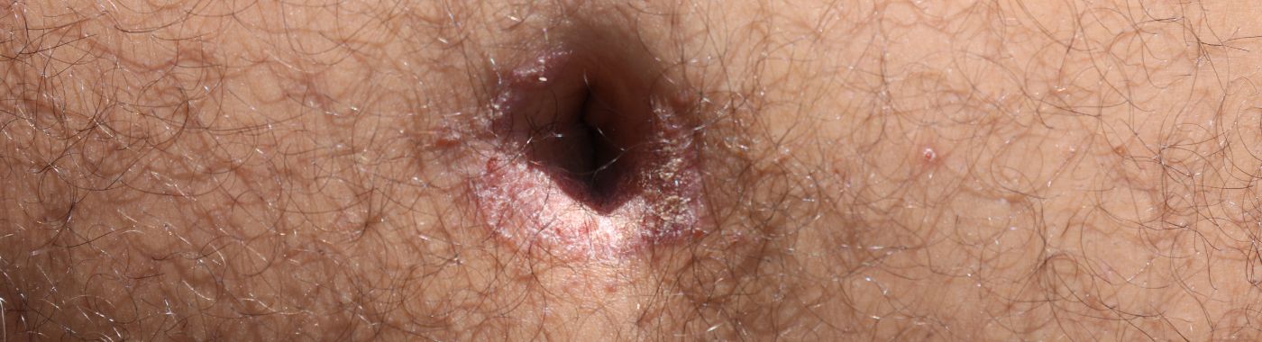 Belly Button Yeast Infection - Causes, Symptoms, Diagnosis, Treatment, and Prevention