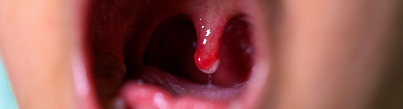 Bifid Uvula - Causes, Symptoms, Diagnosis, Treatment, and Prevention