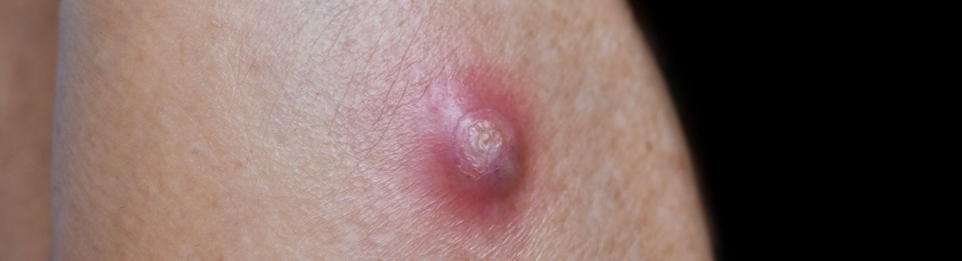 Boils And Carbuncles - Causes, Symptoms, Diagnosis, Treatment, and Prevention