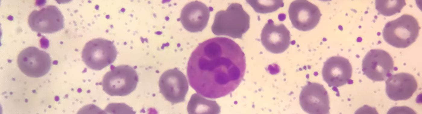 Bone marrow failure syndrome - Causes, Symptoms, Diagnosis, Treatment, and Prevention