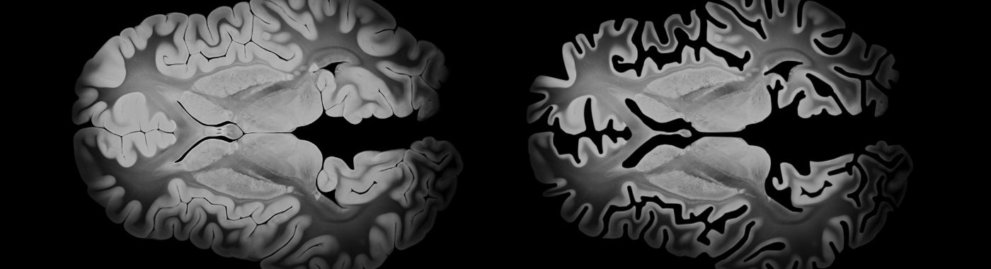 Brain Atrophy - Causes, Symptoms, Diagnosis, Treatment, and Prevention