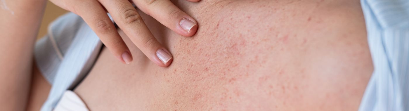 Breast Eczema - Causes, Symptoms, Diagnosis, Treatment, and Prevention