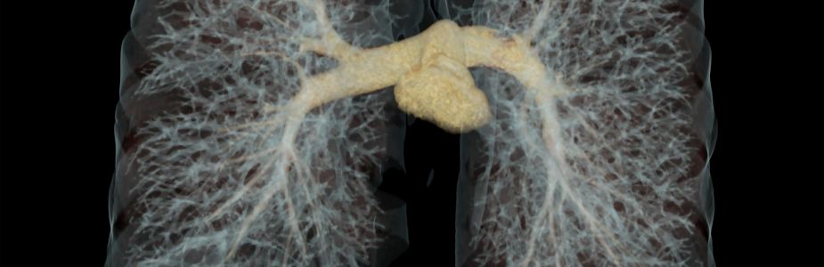 Broncho-Alveolar Lavage (BAL)