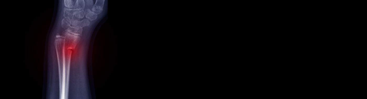 Buckle Fracture - Causes, Symptoms, Diagnosis, Treatment, and Prevention