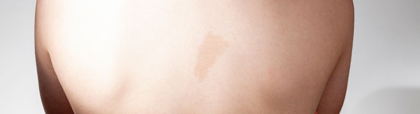 Cafe Au Lait Spots - Causes, Symptoms, Diagnosis, Treatment, and Prevention
