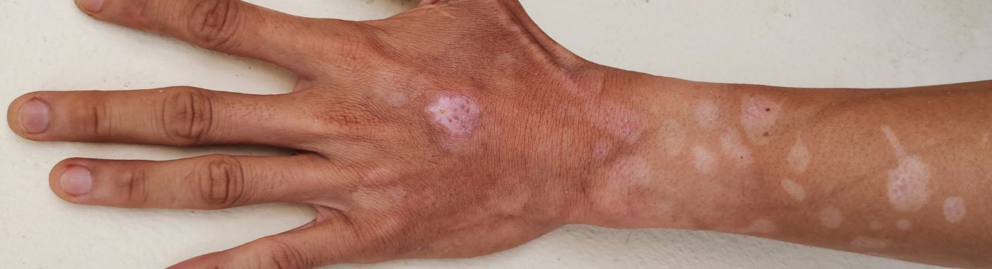 Carney Complex - Causes, Symptoms, Diagnosis, Treatment, and Prevention