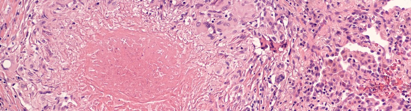 Caseous Necrosis - Causes, Symptoms, Diagnosis, Treatment, and Prevention