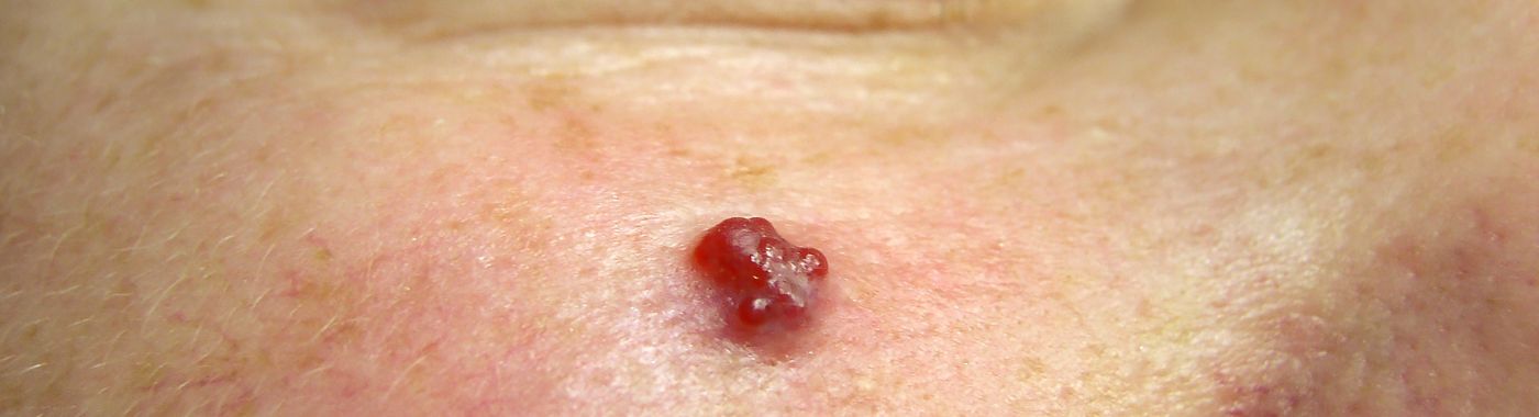 Cavernous Hemangioma - Causes, Symptoms, Diagnosis, Treatment, and Prevention