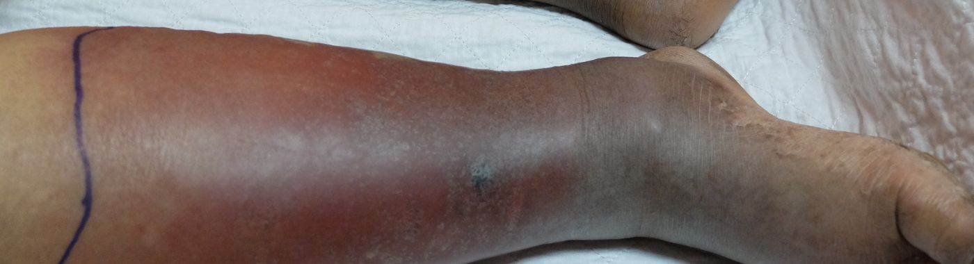Cellulitis