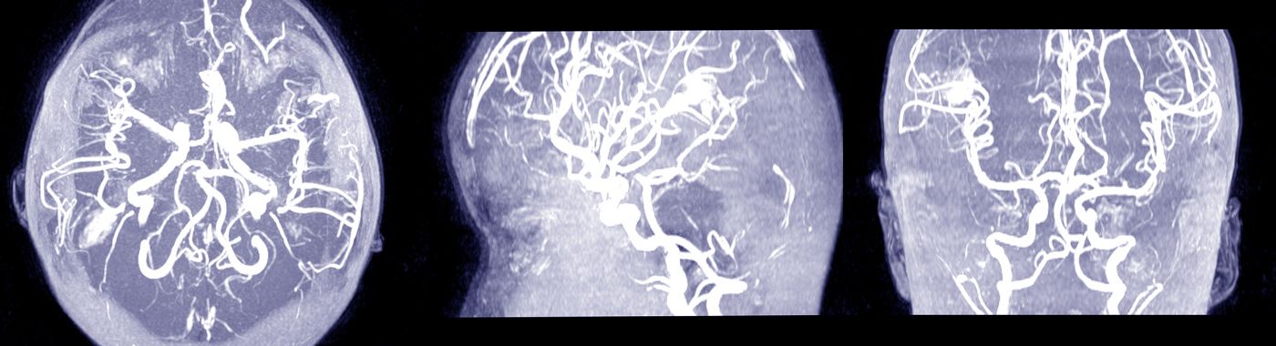 Cerebral Venous Sinus Thrombosis - Causes, Symptoms, Diagnosis, Treatment, and Prevention
