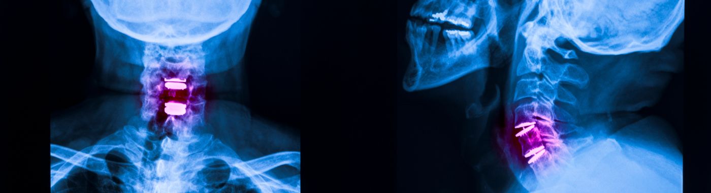 Cervical Radiculopathy