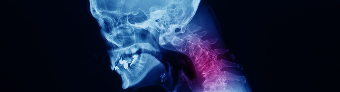 Cervical Spondylosis - Causes, Symptoms, Diagnosis, Treatment, and Prevention