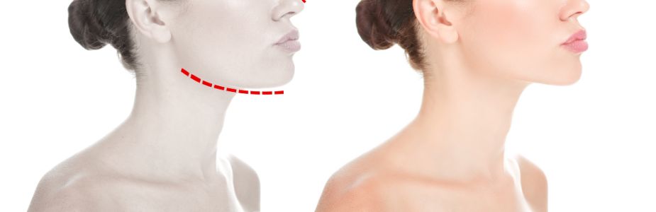Chin Augmentation (Genioplasty)