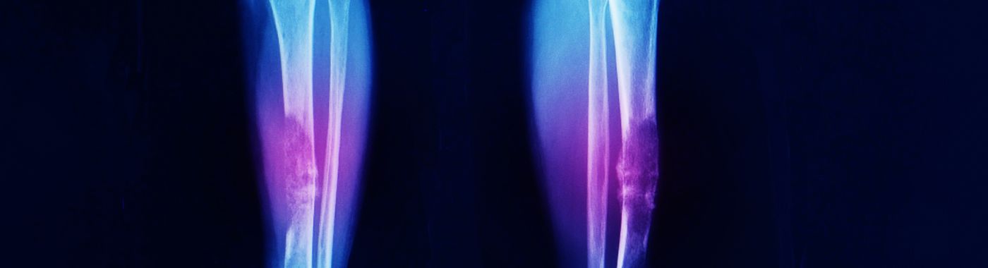 Chondroblastoma - Causes, Symptoms, Diagnosis, Treatment, and Prevention