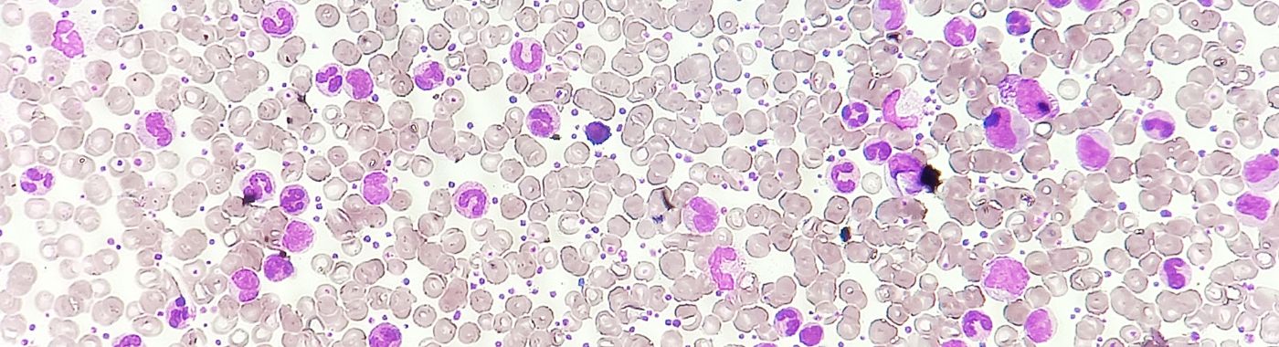 Chronic Myelogenous Leukemia - Early Signs, Risk Factors, Diagnosis, and Treatment Explained