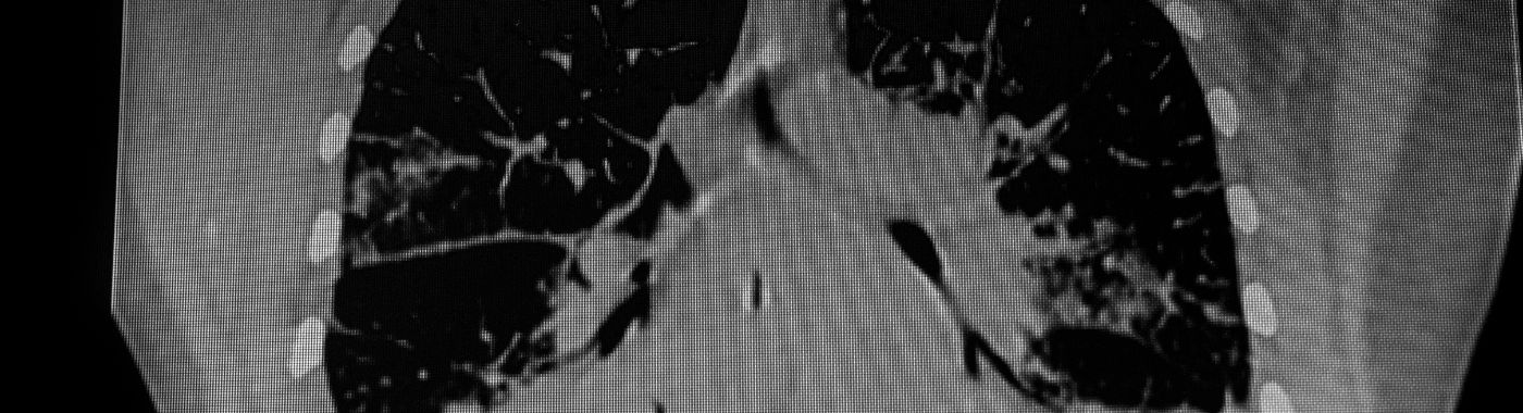 Chylothorax - Causes, Symptoms, Diagnosis, Treatment, and Prevention