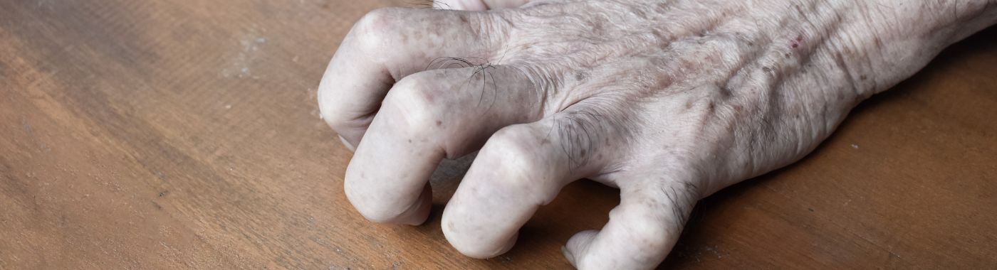 Claw Hand - Causes, Symptoms, Diagnosis, Treatment, and Prevention