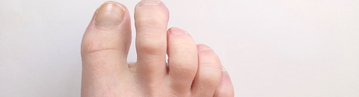 Claw Toes - Causes, Symptoms, Diagnosis, Treatment, and Prevention