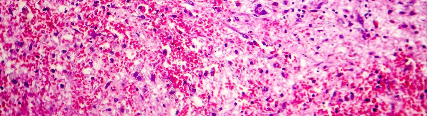 Coagulative Necrosis - Causes, Symptoms, Diagnosis, Treatment, and Prevention