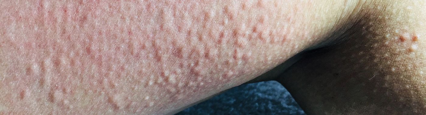 Cold Urticaria - Causes, Symptoms, Diagnosis, Treatment, and Prevention