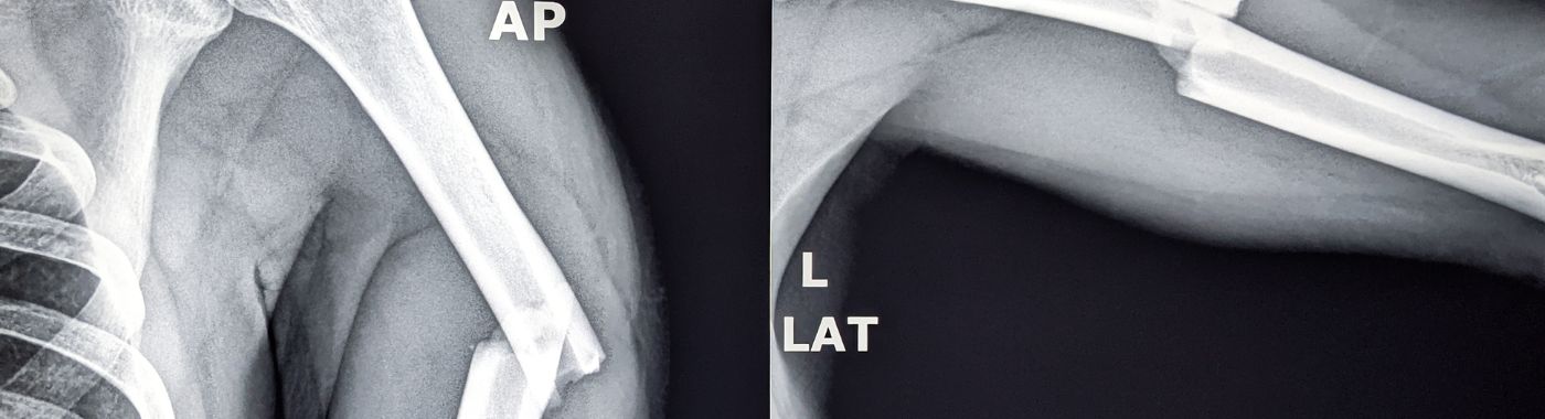 Compound Fracture - Causes, Symptoms, Diagnosis, Treatment, and Prevention