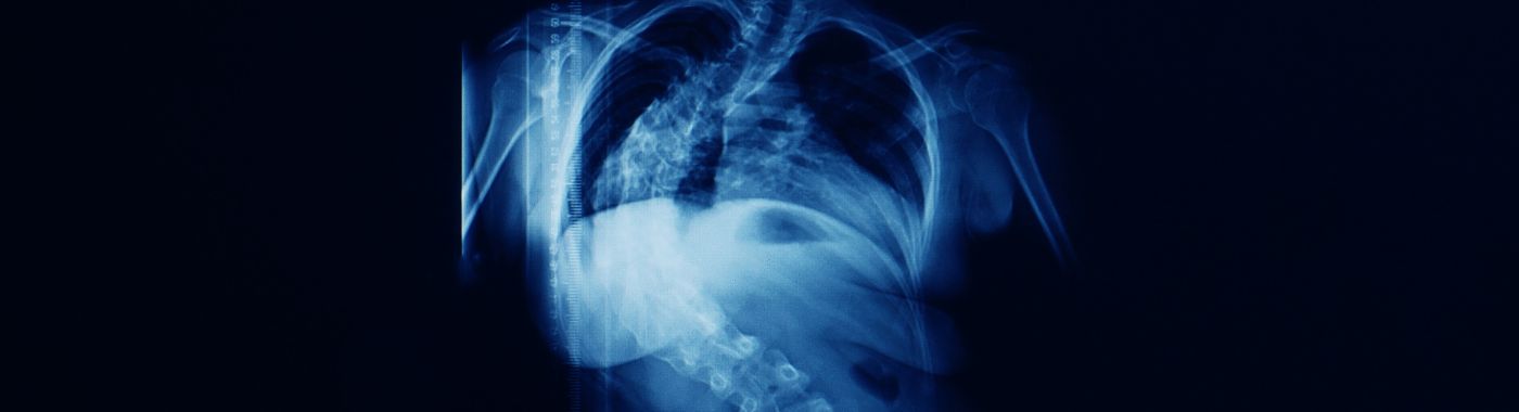 Congenital Scoliosis - Causes, Symptoms, Diagnosis, Treatment, and Prevention