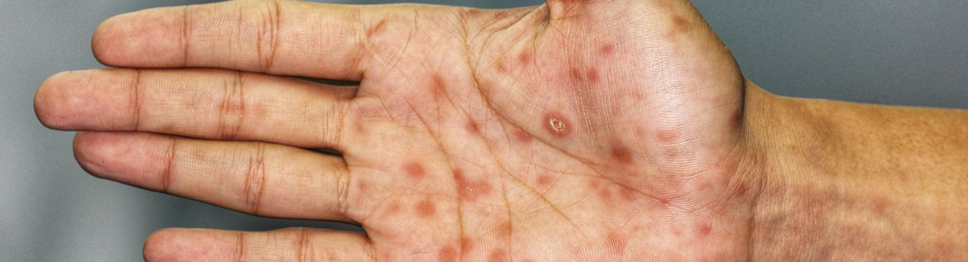 Congenital Syphilis - Causes, Symptoms, Diagnosis, Treatment, and Prevention