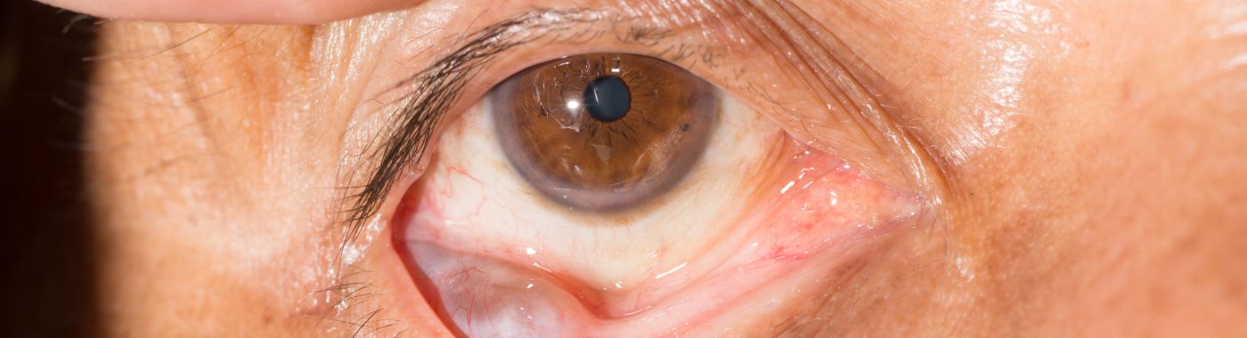 Conjunctival Cyst - Causes, Symptoms, Diagnosis, Treatment, and Prevention