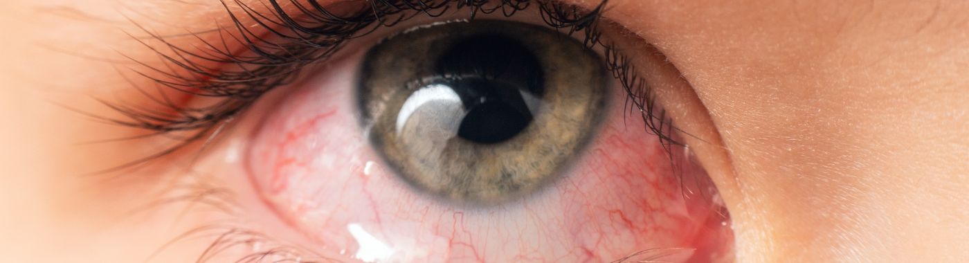 Conjunctivitis