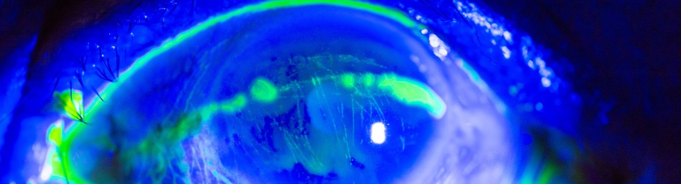 Corneal Abrasion - Causes, Symptoms, Diagnosis, Treatment, and Prevention