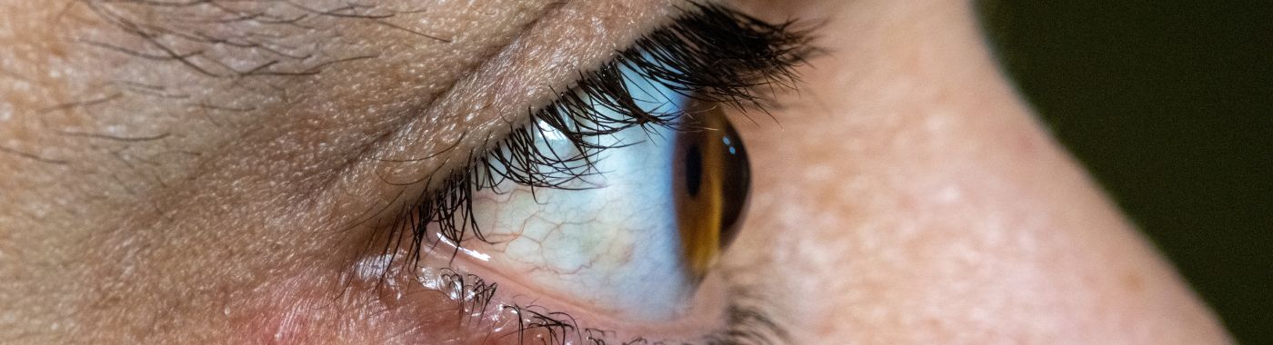Corneal Ectasia - Causes, Symptoms, Diagnosis, Treatment, and Prevention
