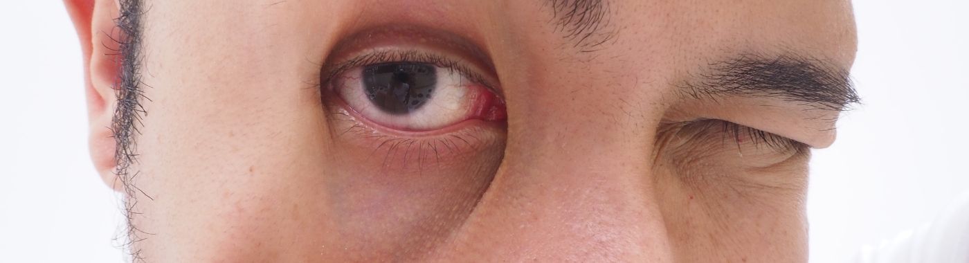 Corneal Edema - Causes, Symptoms, Diagnosis, Treatment, and Prevention
