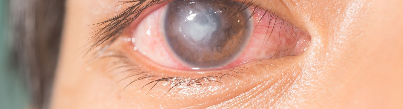 Corneal Ulcer - Causes, Symptoms, Diagnosis, Treatment, and Prevention